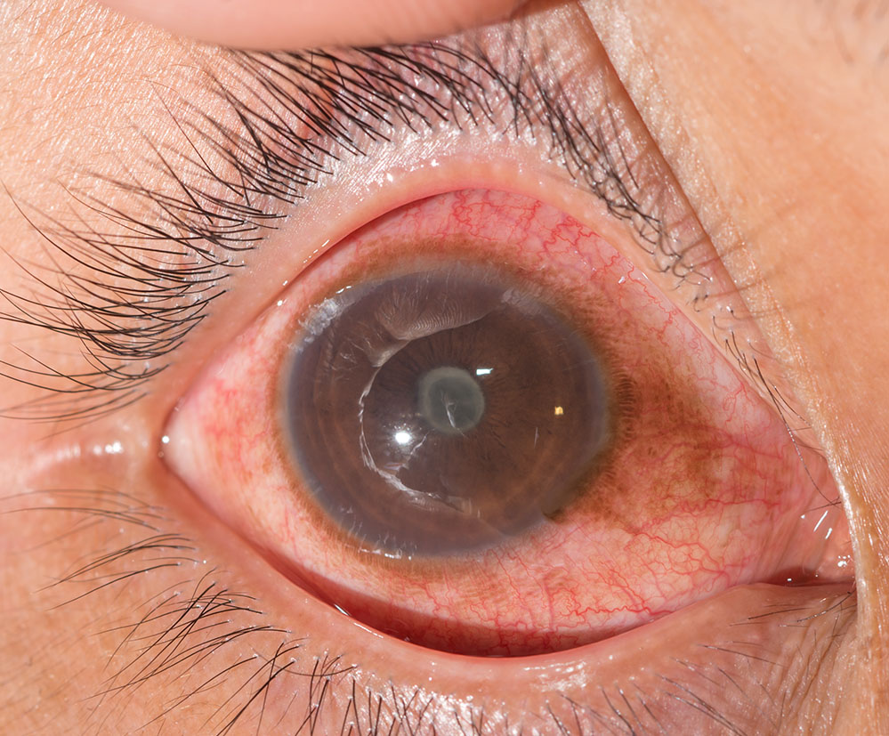 Vordere%20Uveitis%20mit%20hinteren%20Synechien